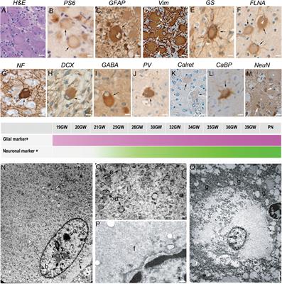 Progression of Fetal Brain Lesions in Tuberous Sclerosis Complex